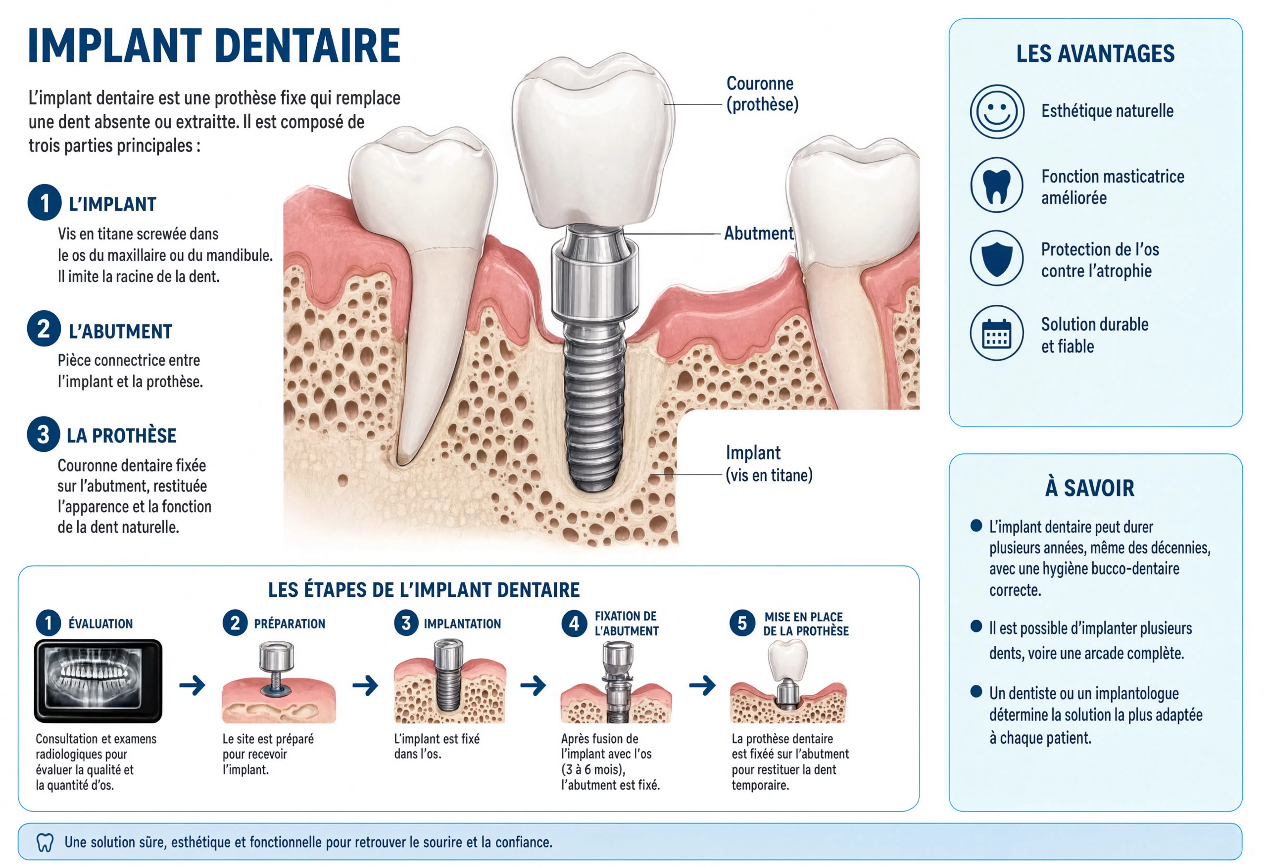 Schéma expliquant le fonctionnement des implants dentaires, représentant un implant inséré dans l’os maxillaire, un pilier et une couronne, avec les différentes parties identifiées, les étapes de la procédure et ses avantages, le tout en français.